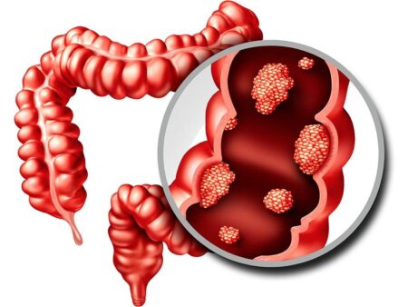 Bowel Cancer in Wellington: Over 100 Lives at Risk — Don’t Ignore the Signs